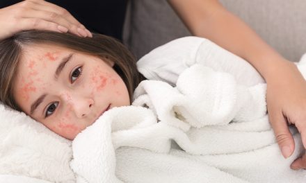 Campak: Penyakit Menular Yang Harus Diwaspadai