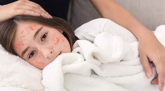 Campak: Penyakit Menular Yang Harus Diwaspadai