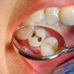 Dampak Buruk Gigi Berlubang Bagi Kesehatan Tubuh