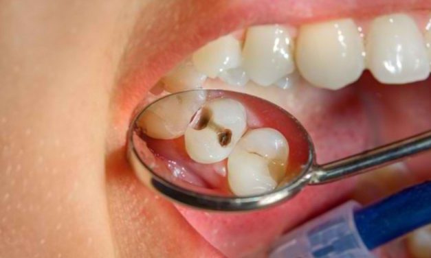 Dampak Buruk Gigi Berlubang Bagi Kesehatan Tubuh